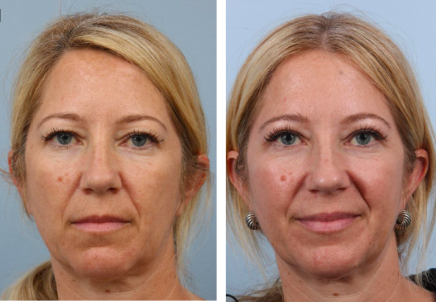 Example of eyelid surgery for cosmetic reasons