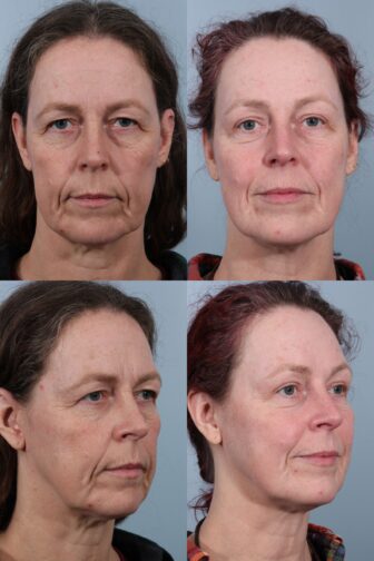 Example of a medically necessary blepharoplasty that would be covered by insurance