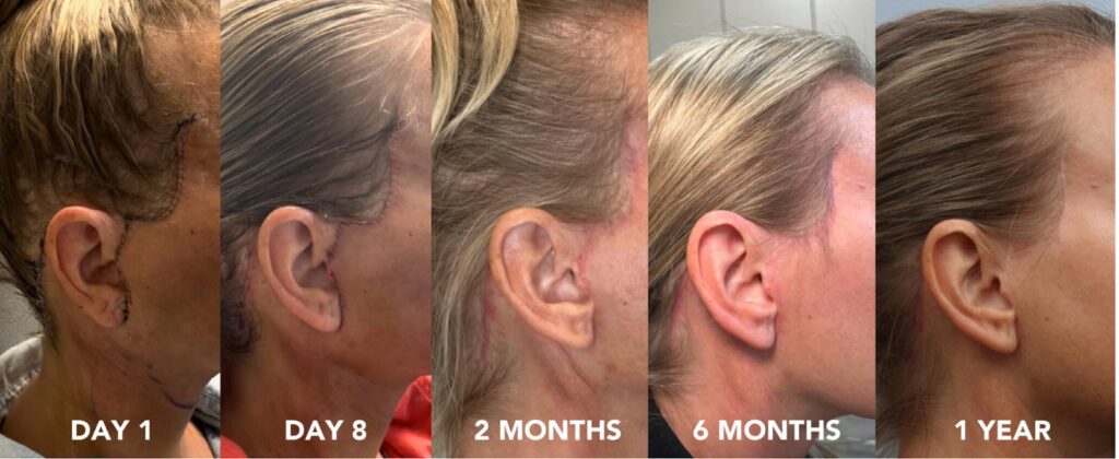 Deep plane facelift recovery timeline by Dr. Williams showing incision healing and scar fading from Day 1, Day 8, 2 months, 6 months, to 1 year after surgery
