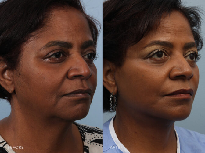 This is a side by side view photos of a woman's face before and after Deep Plane Lower Face and Neck Lift procedure. Before photo shows a bigger look and more pronounced neck with her loose and sagging skin while after photo shows a toned and recontoured shape of her neck.| Albany, Latham, Saratoga NY, Plastic Surgery