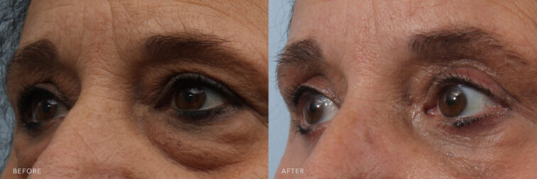 A side by side view photos of a woman's upper face before and after Transconjunctival Blepharoplasty procedure. Before photo shows a sagging skin that disturbs the natural contour of her upper eyelids and sometimes impairing vision while after photo shows a removed excess skin from her upper eyelids and reduced bagginess from her lower eyelids. | Albany, Latham, Saratoga NY, Plastic Surgery