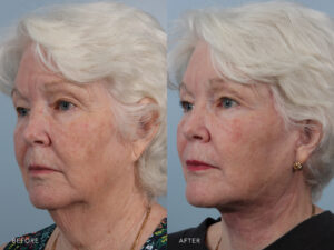 This is a side by side view photos of a woman's face before and after Deep Plane Lower Face and Neck Lift procedure. Before photo shows a drooping and sagging skin of her cheeks and jowls while after photo shows a removed loose skin of her cheeks and neckline that improves her overall appearance.| Albany, Latham, Saratoga NY, Plastic Surgery