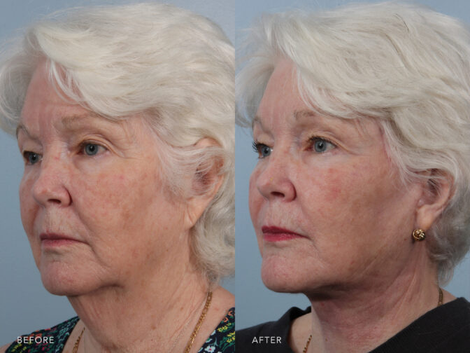 This is a side by side view photos of a woman's face before and after Deep Plane Lower Face and Neck Lift procedure. Before photo shows a drooping and sagging skin of her cheeks and jowls while after photo shows a removed loose skin of her cheeks and neckline that improves her overall appearance.| Albany, Latham, Saratoga NY, Plastic Surgery