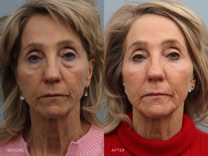A photos of a woman's face before and after Bilateral Lower Lid Transconjunctival Blepharoplasty procedure. Before photo shows fat pockets around and below her eyes while after photo shows fats has been removed which gave her a tightened lower eyelid skin.| Albany, Latham, Saratoga NY, Plastic Surgery