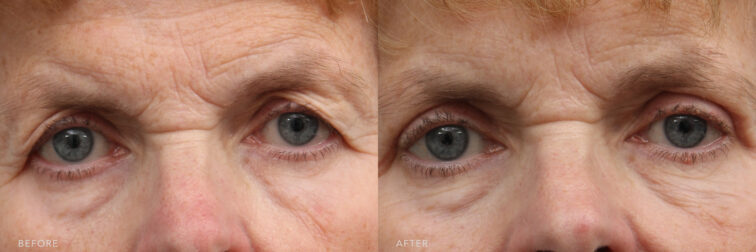 A photos of a woman's upper face before and after Bilateral Upper Blepharoplasty procedure. Before photo shows a droopy upper lids and bags under her eyes while after photo shows a younger and more rested look with her removed excess fat, muscle and sagging skin. | Albany, Latham, Saratoga NY, Plastic Surgery