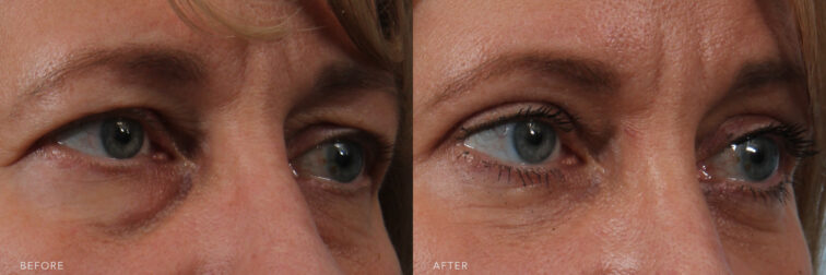 A photos of a woman's upper face before and after Transconjunctival Bleharoplasty procedure. Before photo shows unattractive bulge below her eyes while after photo shows a completely natural eye without any visible sign of scars or over-pulled.| Albany, Latham, Saratoga NY, Plastic Surgery