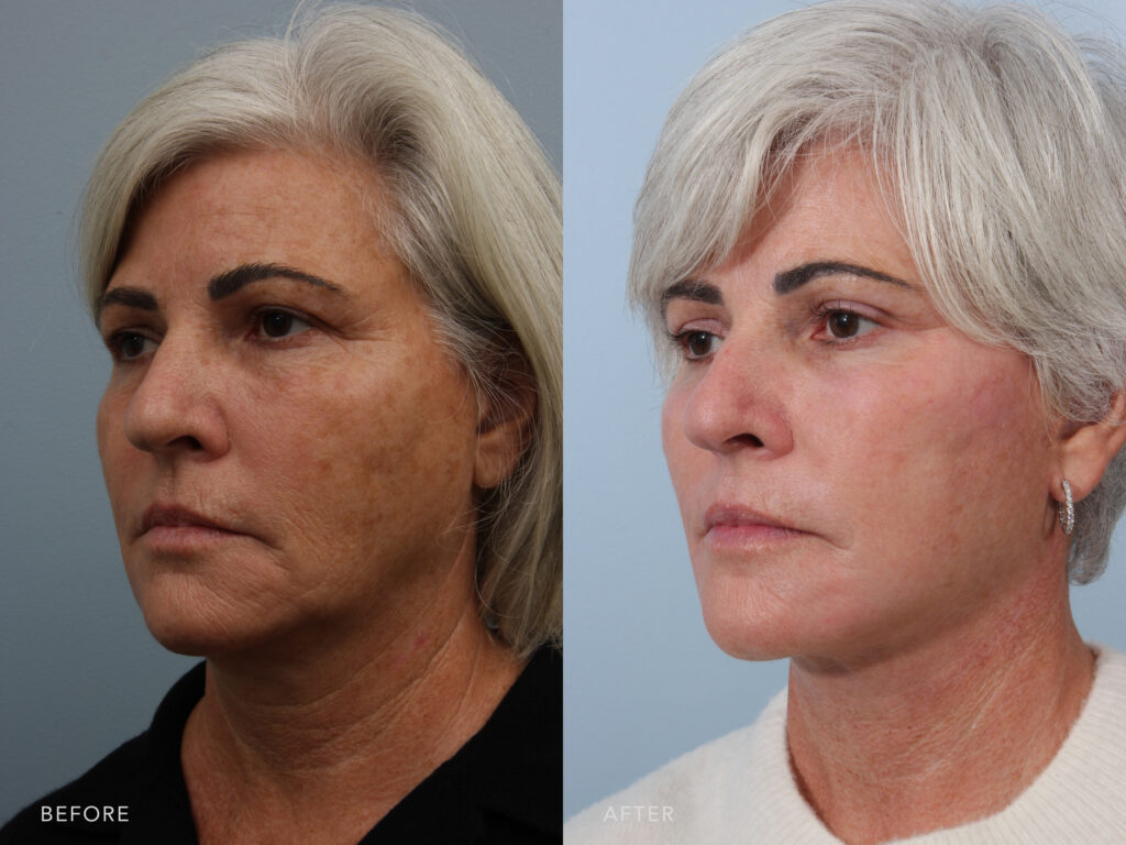 This is a side by side view photos of a woman's face before and after Deep Plane Lower Face and Neck Lift procedure. Before photo shows a loose hanging neck and cheek skin while after photo shows a reduced appearance of sagging jowls and naturally lifted cheeks.| Albany, Latham, Saratoga NY, Plastic Surgery