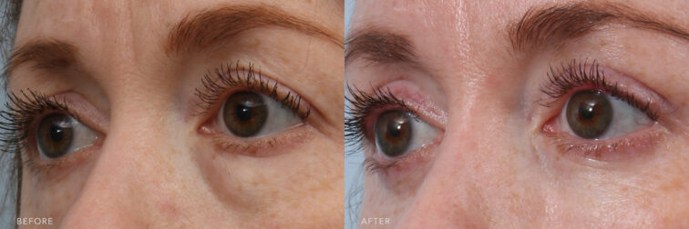 A photos of a woman's upper face before and after Bilateral Lower Lid Transconjunctival Blepharoplasty procedure. Before photo shows an abundance of lower eyelid fat prolapse while after photo shows a soften fine wrinkles and lines in the eye area.| Albany, Latham, Saratoga NY, Plastic Surgery