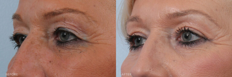A photos of a woman's upper face before and after Bilateral Sliver Upper Blepharoplasty procedure. Before photo shows excess skin of her upper eyelids that caused to lost a defined upper eyelid crease while after photo shows lifted eyelids by removing excess eyelid skin.| Albany, Latham, Saratoga NY, Plastic Surgery
