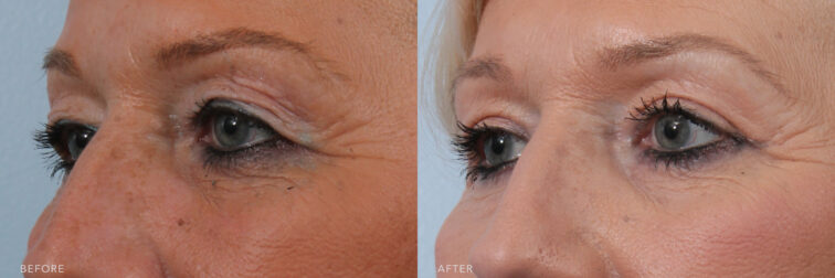 A photos of a woman's upper face before and after Bilateral Sliver Upper Blepharoplasty procedure. Before photo shows excess skin of her upper eyelids that caused to lost a defined upper eyelid crease while after photo shows lifted eyelids by removing excess eyelid skin.| Albany, Latham, Saratoga NY, Plastic Surgery