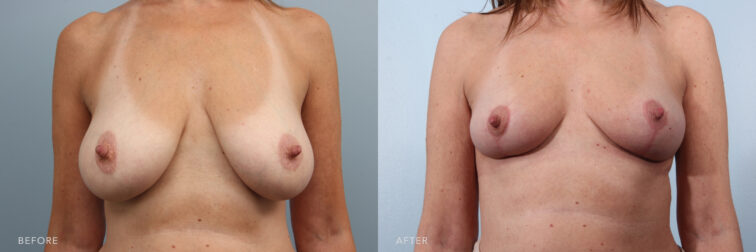 A photos of a woman's body before and after Breast Reduction procedure. Before photo shows excess breast tissue and fat that caused sagging and stretched skin while after photo shows a reduced size and weight of her breasts leaving her a better proportioned of her body.| Albany, Latham, Saratoga NY, Plastic Surgery