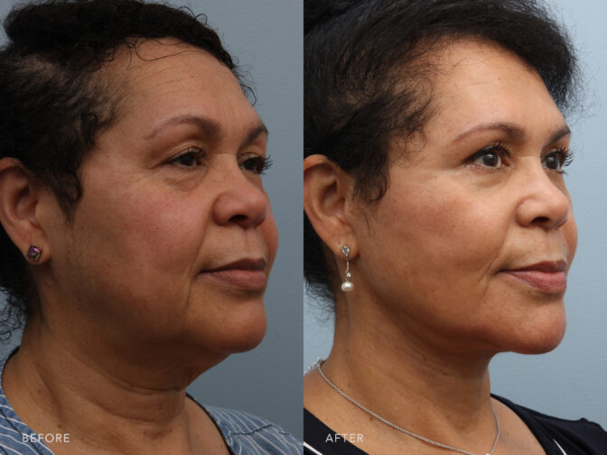This is a side by side view photos of a woman's face before and after Deep Plane Lower Face and Neck Lift procedure. Before photo shows a layer of fats that formed below her chin while after photo shows melted fats and contoured skin leaving a thinner look on her face. | Albany, Latham, Saratoga NY, Plastic Surgery