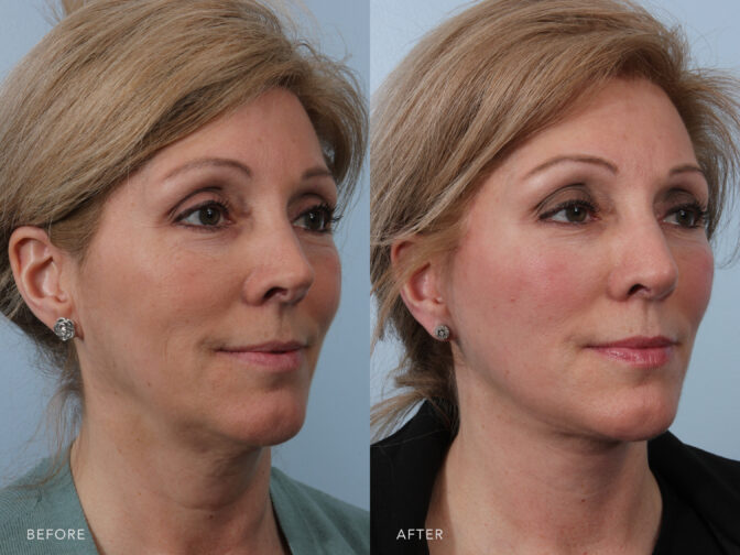 This is a side by side view photos of a woman's face before and after Deep Plane Lower Face and Neck Lift procedure. Before photo shows a sagging skin around the cheeks and mouth while after photo shows a repositioned and sculpted fat and tissues in the jaw and cheeks leaving a fuller look.| Albany, Latham, Saratoga NY, Plastic Surgery