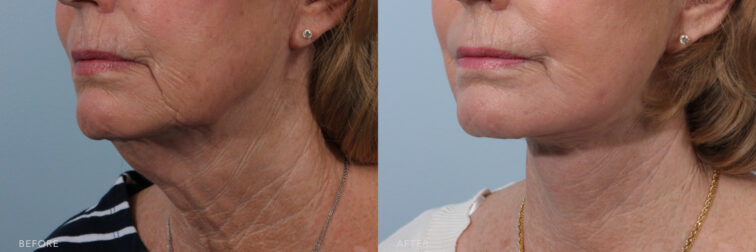 This is a side by side view photos of a woman's lower face before and after Deep Plane Lower Face and Neck Lift procedure. Before photo shows sunken cheeks with folds around the mouth area while after photo shows a firmer and smoother skin with her contoured jawline. | Albany, Latham, Saratoga NY, Plastic Surgery
