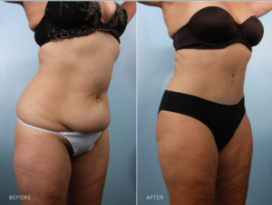 Before and after results of liposuction surgery