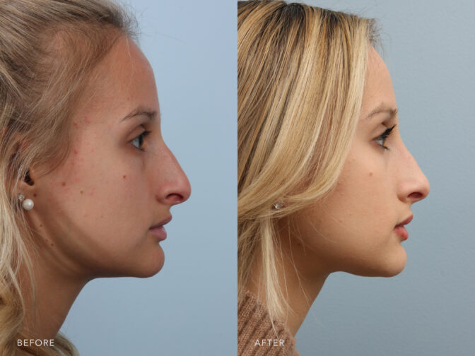 This is a side by side view photos of a woman's face before and after Cosmetic Endosanasl Rhinoplasty procedure. Before photo shows a poorly aligned nose when looking from the side view while after photo shows a reconstructed nose to help restore a more normal alignment.| Albany, Latham, Saratoga NY, Plastic Surgery