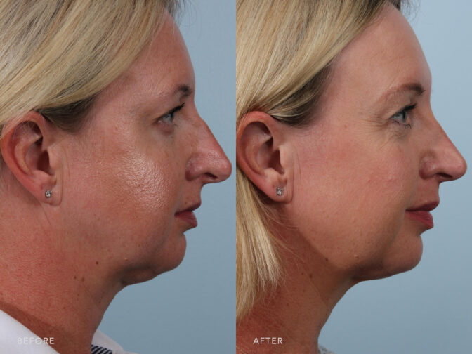 This is a side by side view photos of a woman's face before and after Endonasal Cosmetic Rhinoplasty procedure. Before photo shows an outward and downward angled nose while after photo shows a raised nasal tip with her reshaped and shortened nose.| Albany, Latham, Saratoga NY, Plastic Surgery