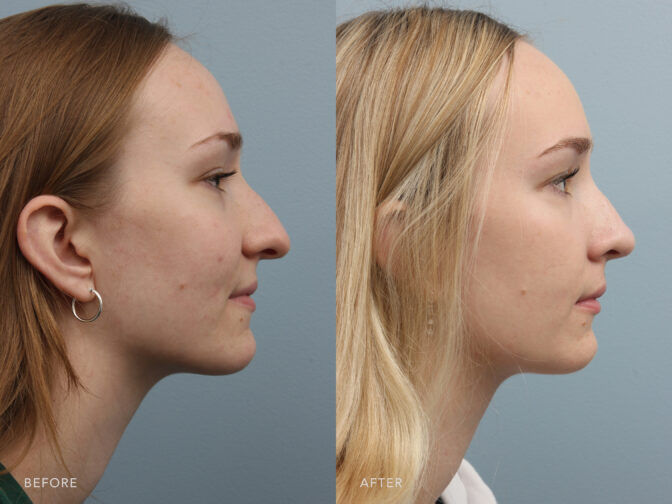 A side-by-side view of a woman's face before and after the Endonasal Cosmetic Rhinoplasty procedure. Before photo shows a combination of curves and deviations along the length of her nose, while the after photo shows a reduced nasal hump, refined nasal tip, and narrowed nostrils resulting in a more proportional and balanced overall facial appearance.. | Albany, Latham, Saratoga NY, Plastic Surgery