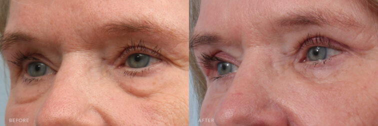 This is a photo of a woman's face before and after Bilateral Lower Eyelid Transconjunctival Blepharoplasty procedure. Before photo shows fats in her lower eyelids that moved downwards that caused her puffy eyes while after photo shows a more brighter and well rested eyes. | Albany, Latham, Saratoga NY, Plastic Surgery