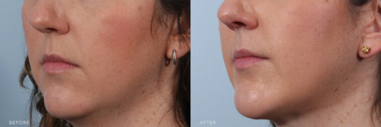 This is a side by side view photos of a woman's lower face before and after Chin Augmentation procedure. Before photo shows a lost of collagen and elasticity that caused her skin to become thinner and loose while after photo shows a more projected chin and jawline with her rejuvenated and tightened skin.| Albany, Latham, Saratoga NY, Plastic Surgery