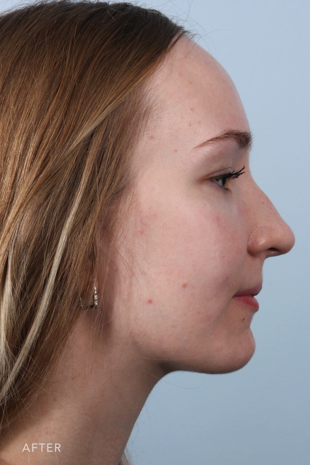 Rhinoplasty & Nasal Reconstruction Pictures | Williams Center Williams ...
