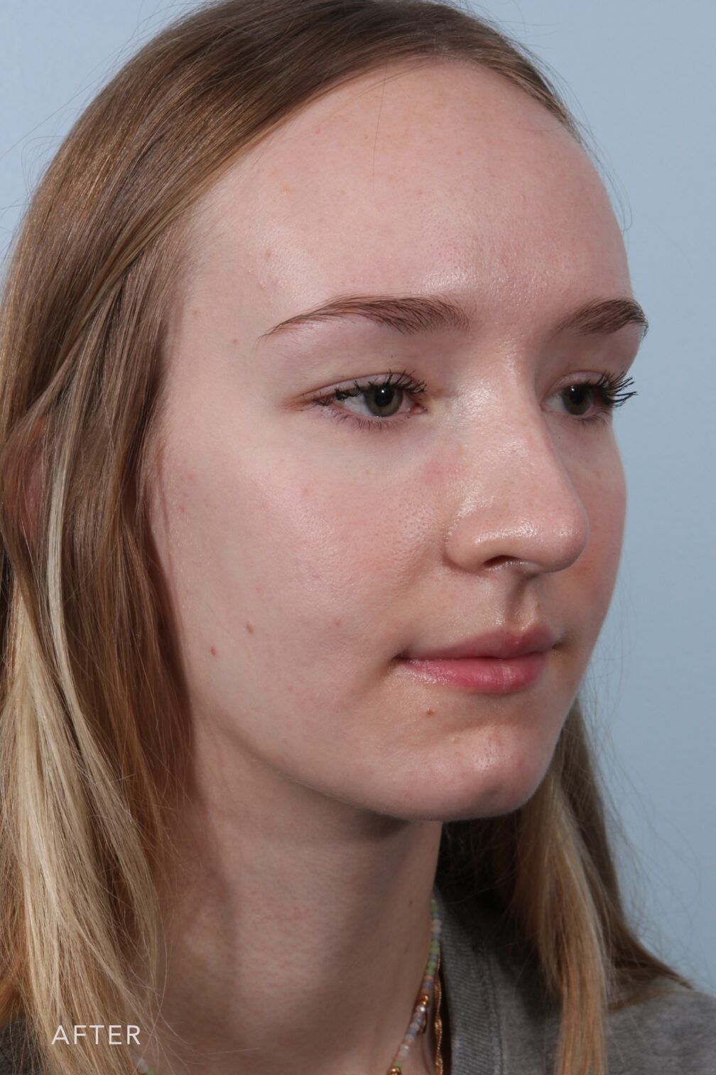 Rhinoplasty & Nasal Reconstruction Pictures | Williams Center Williams ...