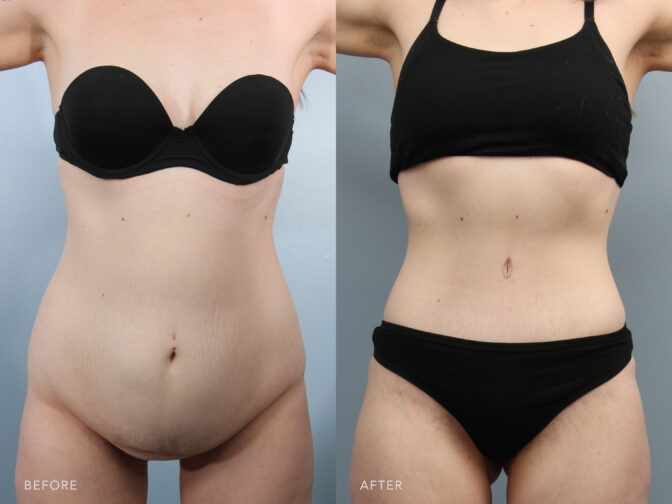 A photos of a woman's body before and after Abdominoplasty with Liposuction procedure. Before photo shows loose and excess skin hanging around her belly while after photo shows a tightened and reshaped abdomen.| Albany, Latham, Saratoga NY, Plastic Surgery