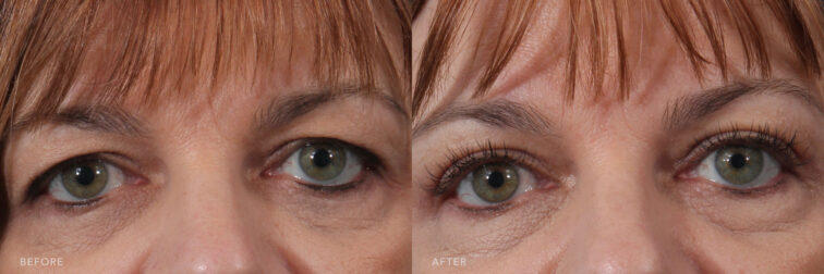 A photo of a woman's upper face before and after the Upper Blepharoplasty procedure. Before photo shows weakened muscles and stretched eyelids, while the after photo shows younger-looking eyes with her redistributed excess fat, muscle, and sagging skin.| Albany, Latham, Saratoga NY, Plastic Surgery