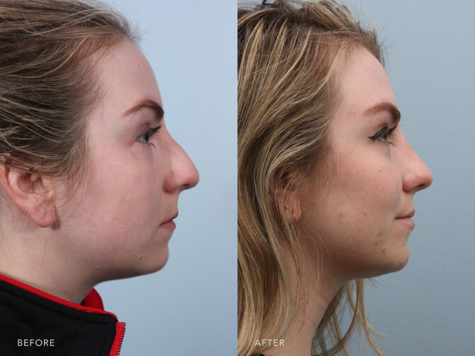 A photo of a woman's face before and after a Cosmetic and Functional Endonasal Rhinoplasty procedure. Before photo shows a twisted or rotated nasal tip which is pointing more towards one side than the other, while the after photo shows well-defined bridge and a smooth contour without any significant bends or angles. | Albany, Latham, Saratoga NY, Plastic Surgery