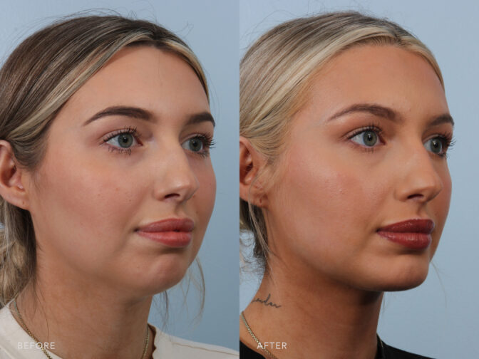 A side-by-side view of a woman's face before and after the Chin Augmentation and Neck Liposuction procedure. The before photo shows a muted chin contour, where her jawline flows into the neck without a clear delineation, contributing to a more blended and less structured appearance. The after photo shows a well-defined chin contour, with a distinct separation between the jawline and neck. The sharp delineation contributes to a more structured and sculpted lower face. | Albany, Latham, Saratoga NY, Plastic Surgery