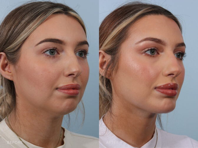 A photos of a woman's face before and after Submental Liposuction with Chin Augmentation procedure. Before photo shows a chin that doesn’t stick out far enough from her face while after photo shows a molded chin bone that gave her a natural and more balanced look.| Albany, Latham, Saratoga NY, Plastic Surgery