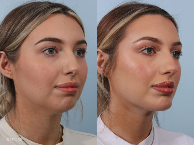 Chin Augmentation Before & After Pictures