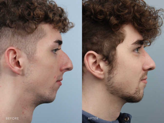 This is a side by side view photos of a man's face before and after Endonasal Cosmetic Rhinoplasty procedure. Before photo shows a nasal airway obstruction caused by his obstructed nasal valves while after photo shows a smoother shaped nose with his removed hump and improved tip definition.| Albany, Latham, Saratoga NY, Plastic Surgery