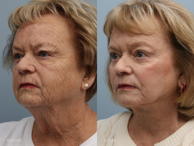 This is a side-by-side view photo of a woman's face before and after Deep Plane Lower Face and Neck Lift procedure. Before photo shows drooping and a less defined neck caused by excess skin and lax neck muscles while after photo shows strengthened neck muscles, which helped to improve her neck’s appearance.| Albany, Latham, Saratoga NY, Plastic Surgery