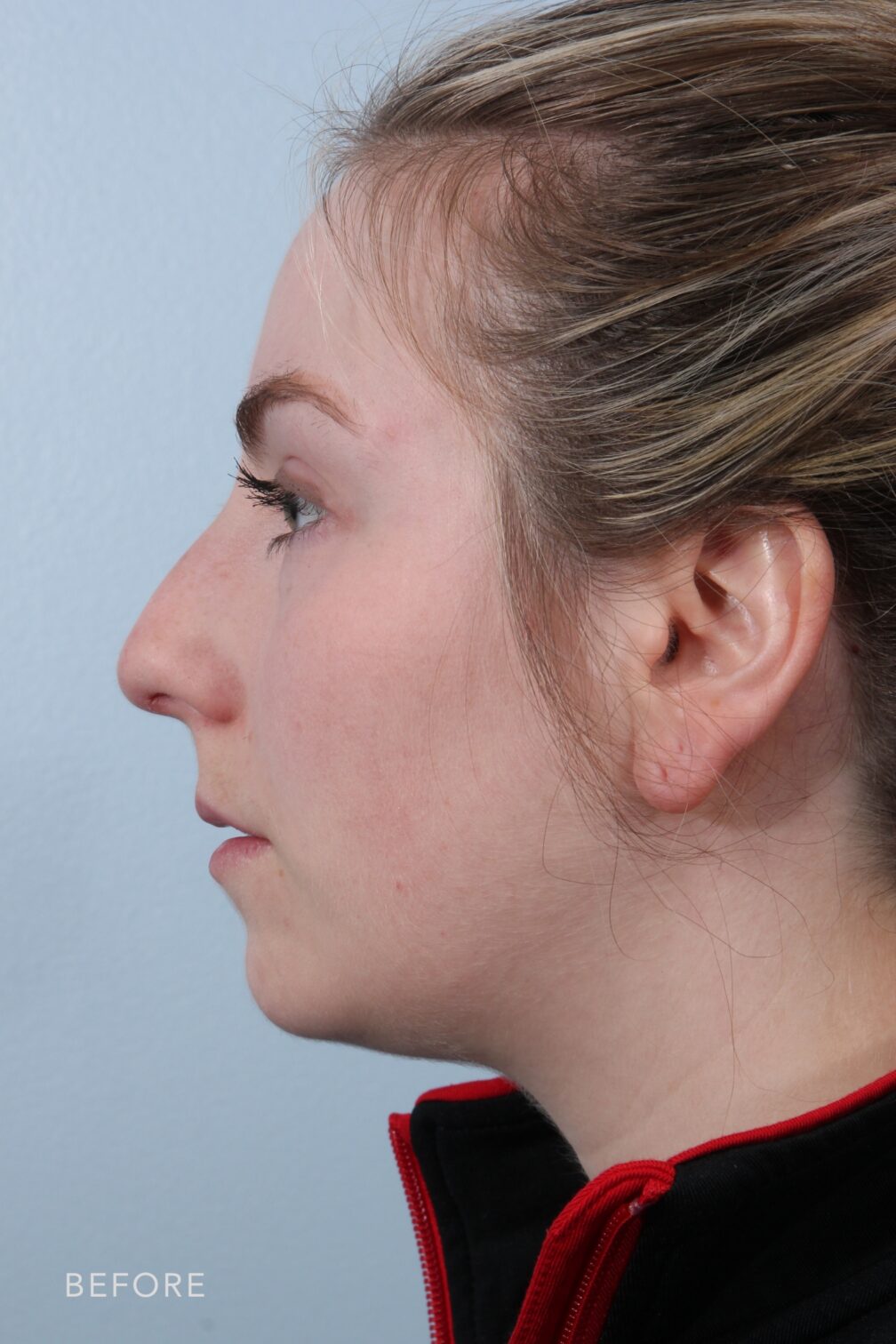 Rhinoplasty & Nasal Reconstruction Pictures | Williams Center Williams ...