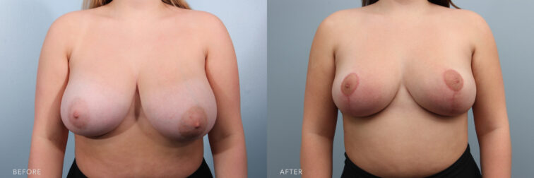 A photo of a woman's body before and after a Bilateral Breast Reduction procedure. Before photo shows unevenly sized breasts, volume, position, or form from the other, while the after photo shows a reduced overall breast volume that helped to achieve an aesthetically pleasing shape. | Albany, Latham, Saratoga NY, Plastic Surgery