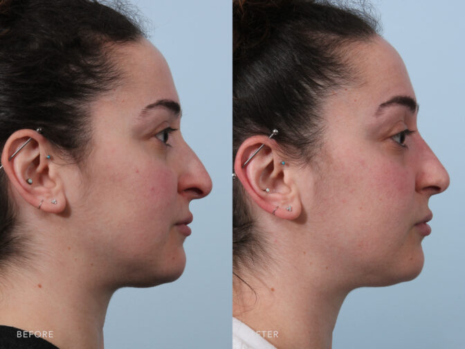 A side-by-side view of a woman's face before and after the Endonasal Cosmetic Rhinoplasty procedure. Before photo shows a rounded or convex shape along her nasal bridge, while the after photo shows a more concave profile resulting in a more balanced and aesthetically pleasing nasal appearance. | Albany, Latham, Saratoga NY, Plastic Surgery