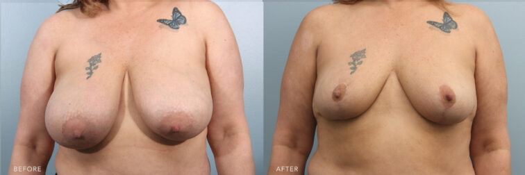This is a photo of a woman's body before and after Bilateral Breast Reduction procedure. Before photo shows a droopy breasts that caused her nipples pointing downwards while after photo shows a repositioned nipples and areola to a natural and more youthful height.| Albany, Latham, Saratoga NY, Plastic Surgery