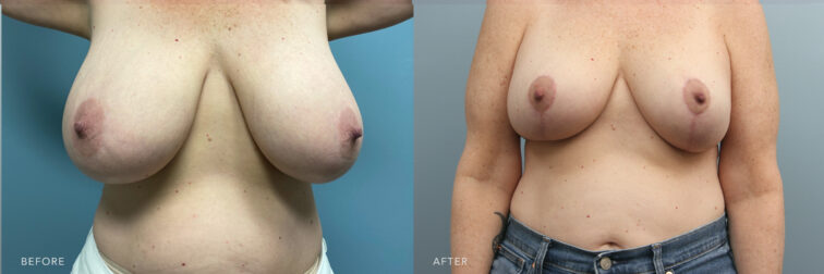 A side-by-side view photo of a woman's upper body before and after the Bilateral Breast Reduction procedure. Before photo shows saggy breasts caused by an increased volume and weight of her tissue, while the after photo shows firmer breasts with her toned-up tissues.| Albany, Latham, Saratoga NY, Plastic Surgery