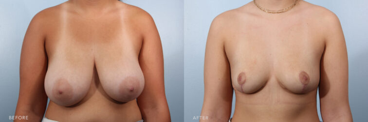 A photo of a woman's upper body shows saggy and large breasts with the weight of her breasts tissue causing them to sag and hang lower on the chest wall. | Albany, Latham, Saratoga NY, Plastic Surgery