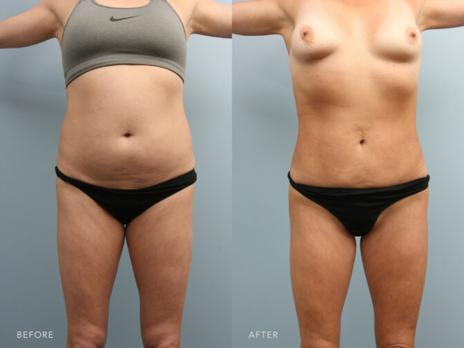 A photo of a woman's body before and after Lipodystrophy of the Abdomen, Back, and Flanks procedure. Before photo shows an apple-shaped body, where most of the fat is concentrated around her waistline and abdominal area. While the after photo appears to be more defined and muscular, with less visible fat underneath her skin, giving it a lean and toned look. | Albany, Latham, Saratoga NY, Plastic Surgery