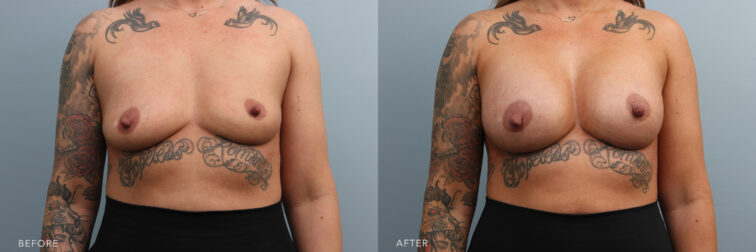 A photo of a woman's upper body before and after a Bilateral Breast Augmentation procedure. Before photo shows breasts with minimal fullness and appears relatively flat, lacking the desired roundness or projection, while the after photo shows breasts with a noticeable volume and plumpness, filling out the upper and lower portions of her breast area.| Albany, Latham, Saratoga NY, Plastic Surgery