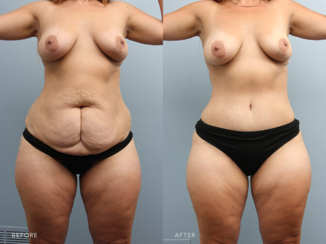 A photo of a woman's body before and after Abdominoplasty with Liposuction of Back Flanks and Abdomen procedure. Before photo shows a combination of excess fat and loose skin creating wrinkles, creases, or folds on the surface of her abdomen, particularly when she's bending or folding her body. While the after photo shows a tighter abdomen exhibiting well-defined contours, with more pronounced muscle definition and a more defined waistline. | Albany, Latham, Saratoga NY, Plastic Surgery