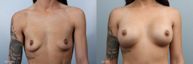 A photo of a woman's upper body before and after the Bilateral Micromastia procedure. Before photo shows breasts that lack projection which is smaller in size compared to the average breast size, while the after photo shows breasts that exhibit a gentle curve or slope, with a gradual transition from the chest wall to the fullest point of her breast. | Albany, Latham, Saratoga NY, Plastic Surgery