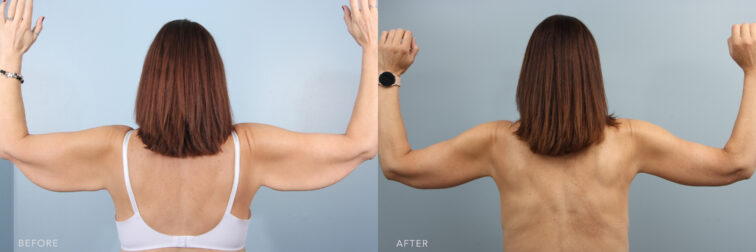 A photo of a woman's upper body before and after the Bilateral Arm Lift Procedure. Before photo shows a wide and thick appearance in her upper arms, which made it noticeable when her arms are raised or extended, while the after photo shows a natural shape of her upper arms resulting in a well-toned between the shoulder and the elbow. | Albany, Latham, Saratoga NY, Plastic Surgery