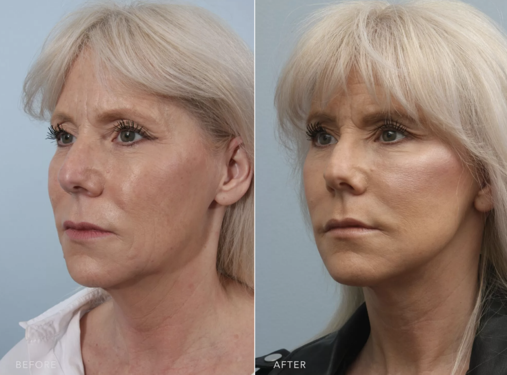 Female patient showcasing results of deep plane facelift