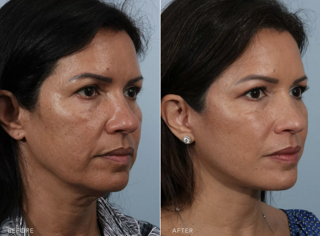 Resultados de um facelift plano profundo realizado pelo Dr. Edwin Williams no The Williams Center