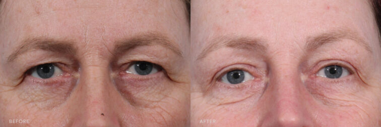 A photos of a woman's upper face before and after Bilateral Brow Lift procedure. Before photo shows frown lines and excess skin on her upper eye lids while after photo shows more youthful appearance with her reduced wrinkles and improved frown lines. | Albany, Latham, Saratoga NY, MedSpa