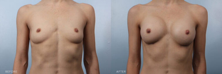 A photo of a woman's upper body before and after a Bilateral Breast Augmentation procedure. Before photo shows a breast that has minimal volume and projection, resulting in a flatter appearance on her chest. While the after photo shows an increased size of her breasts, achieving a fuller and more proportionate figure. | Albany, Latham, Saratoga NY, Plastic Surgery