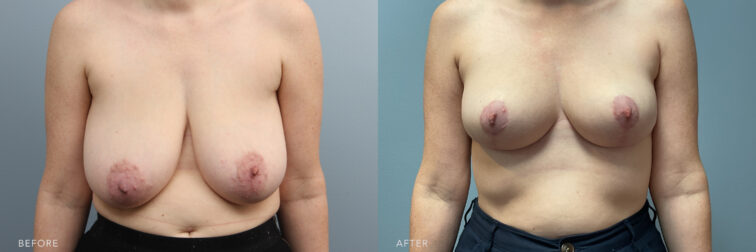 A photo of a woman's upper body before and after Bilateral Micromastia procedure. Before photo shows a breasts that does not maintain a perky or elevated position on her chest due to their size and weight, while the after photo shows firmer breasts that closely adheres to her chest wall, resulting in a more youthful appearance with her breasts maintaining their position higher on the chest. | Albany, Latham, Saratoga NY, Plastic Surgery